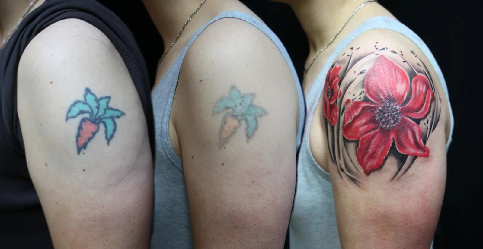 Before-and-after of a shoulder tattoo fading after laser tattoo removal sessions