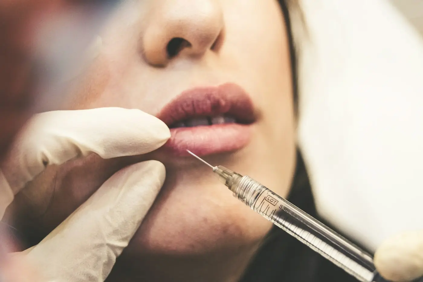 Gloved provider injecting dermal filler into a client's lips